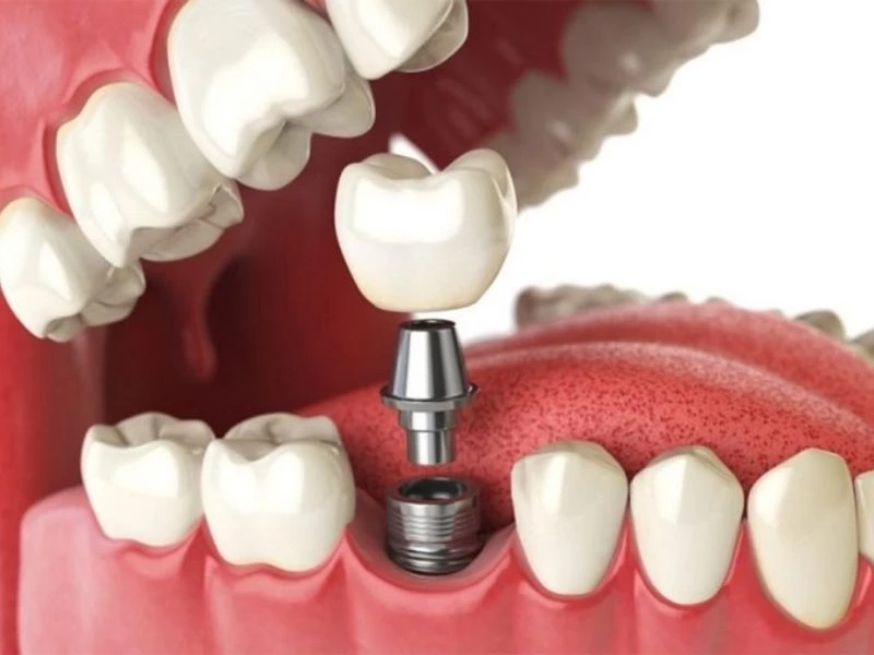 Quy trình trồng răng Implant cần thời gian để trụ Implant tích hợp với xương hàm 