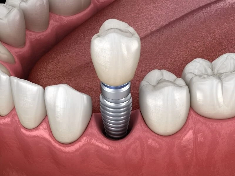Quy trình trồng răng Implant được thực hiện chính xác bằng kỹ thuật cấy trụ hiện đại