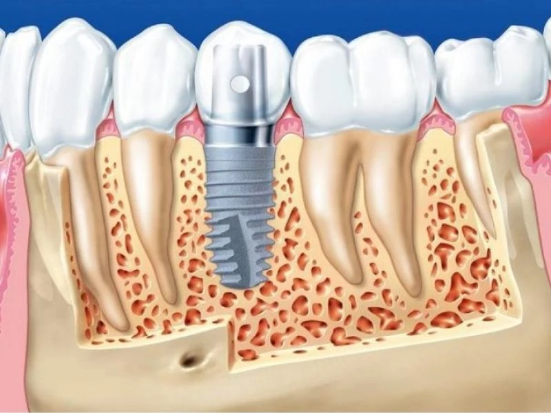 Quy trình trồng răng Implant được thực hiện theo từng bước chuẩn y khoa 