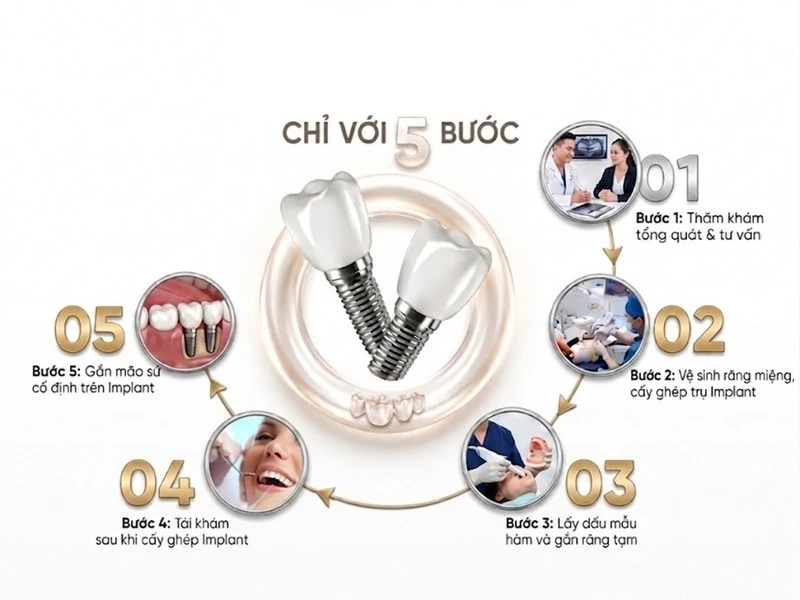 Quy trình trồng răng Implant sử dụng công nghệ CT 3D để xác định vị trí cấy ghép