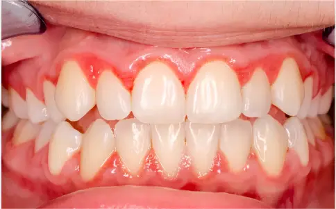 Răng bị viêm nướu