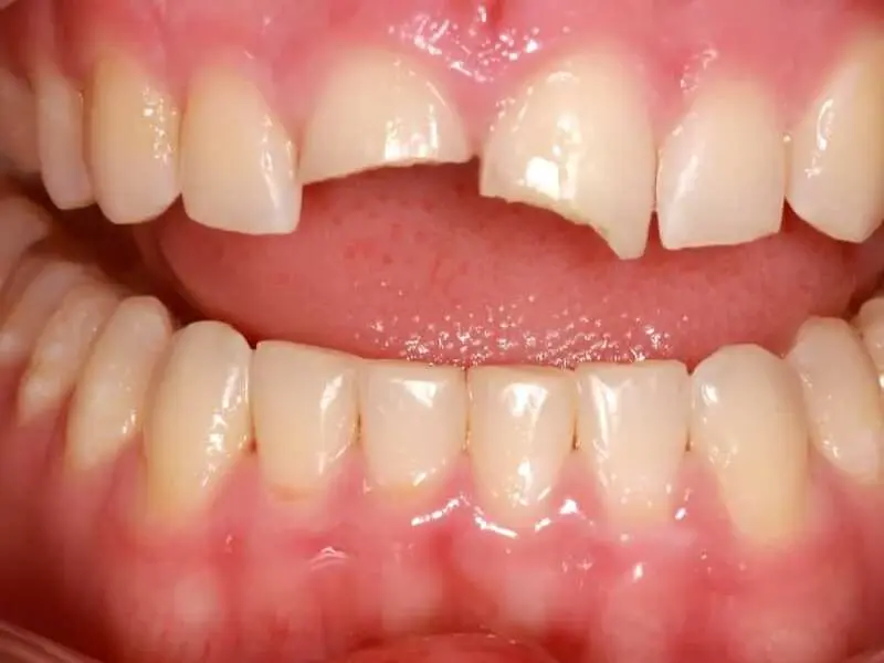 Răng cửa bị gãy mẻ nhỏ dưới một phần ba thân răng ở mức độ nhẹ