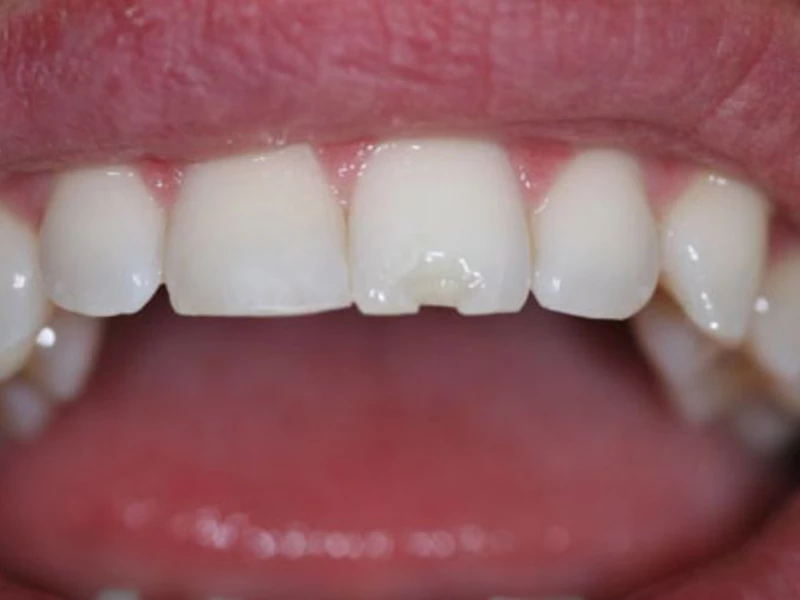 Hình ảnh răng sứ bị nứt, mẻ