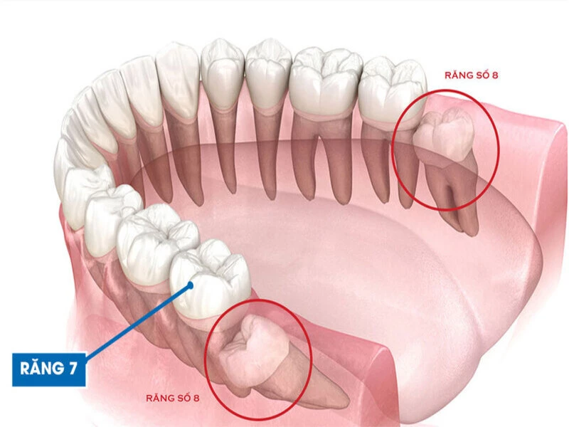 Sơ đồ vị trí răng số 7 khu trú giữa răng số 6 và răng khôn trên cung hàm