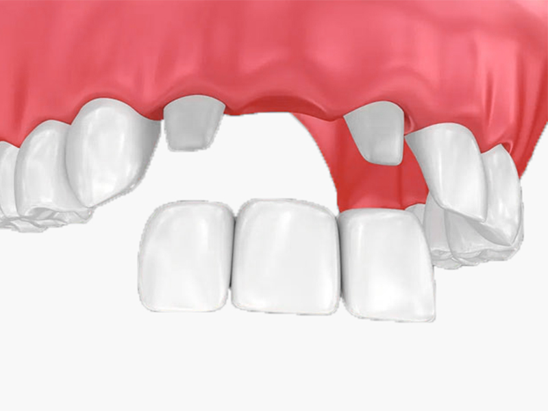 Hình minh họa phương pháp làm cầu răng sứ để phục hình răng bị mất