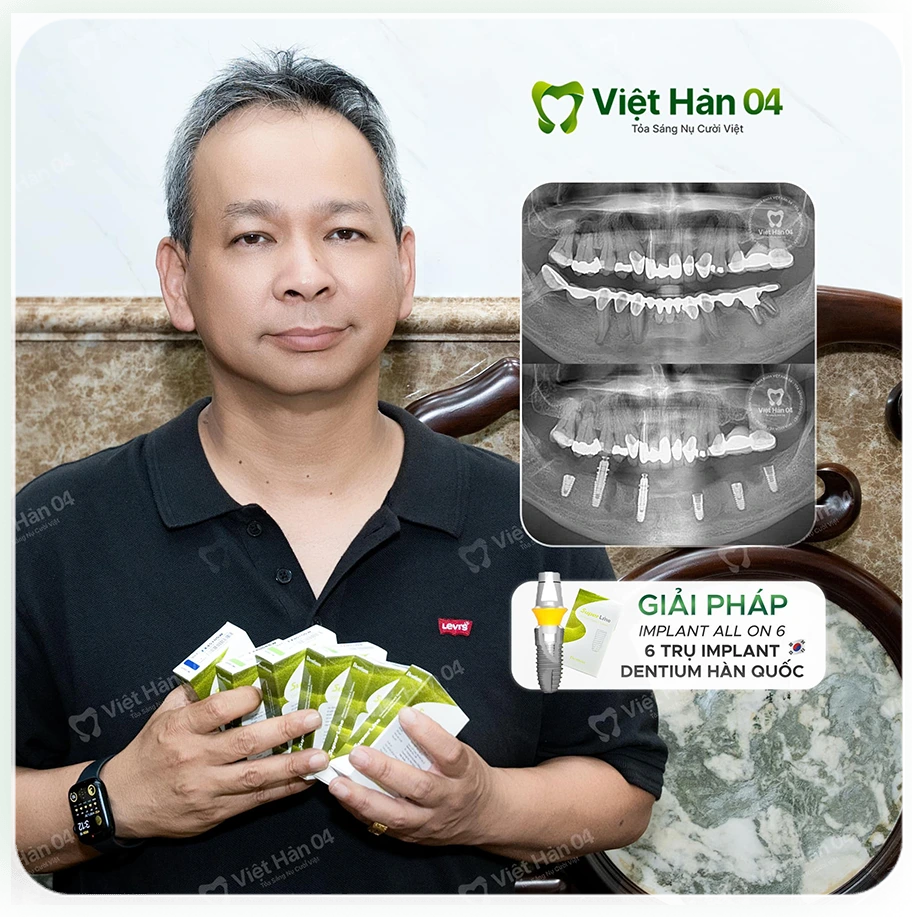 Giải pháp: Implant All On 6 - 6 Trụ Implant Dentium Hàn Quốc