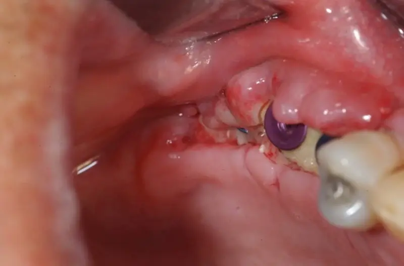 Sưng viêm quanh vị trí cấy răng implant