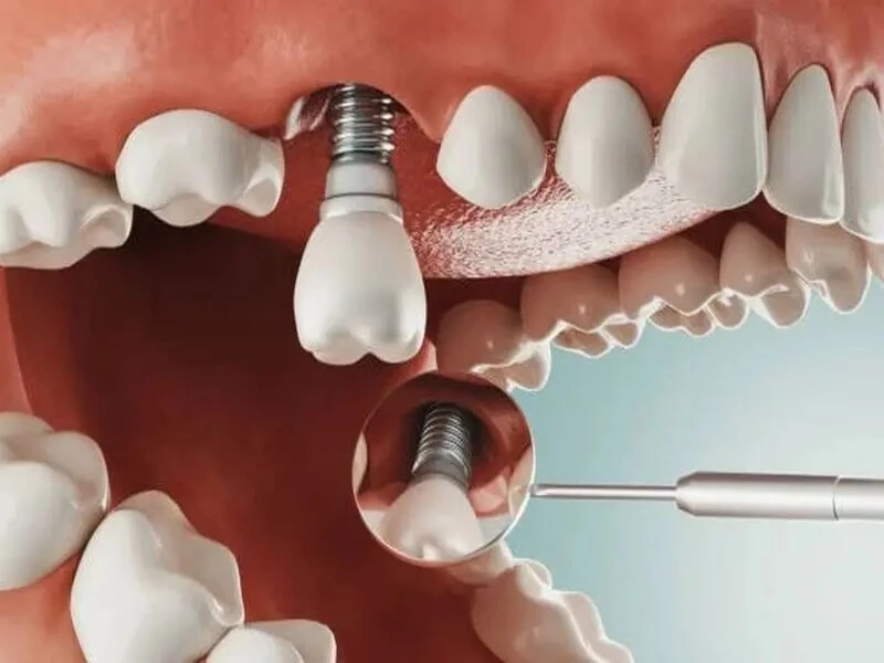 Thời gian cấy ghép implant kéo dài từ 4 đến 6 tháng tùy cơ địa 