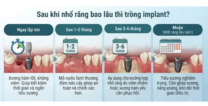 Thời gian cấy ghép implant sau khi nhổ răng theo tình trạng xương nướu 