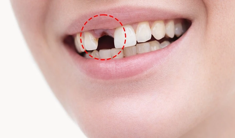 Thời gian trồng răng cửa bị mất cả chân răng phụ thuộc vào phương pháp phục hình 