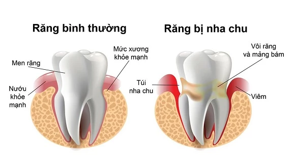 Viêm nha chu là một yếu tố gây mất răng