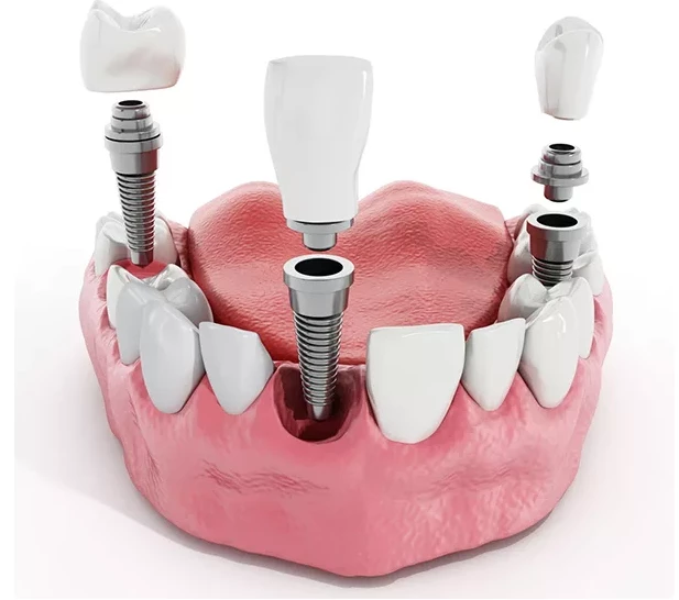 Cấy ghép răng implant