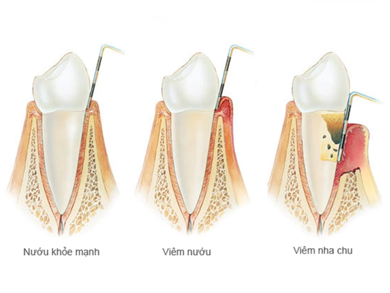Viêm nướu, viêm nha chu