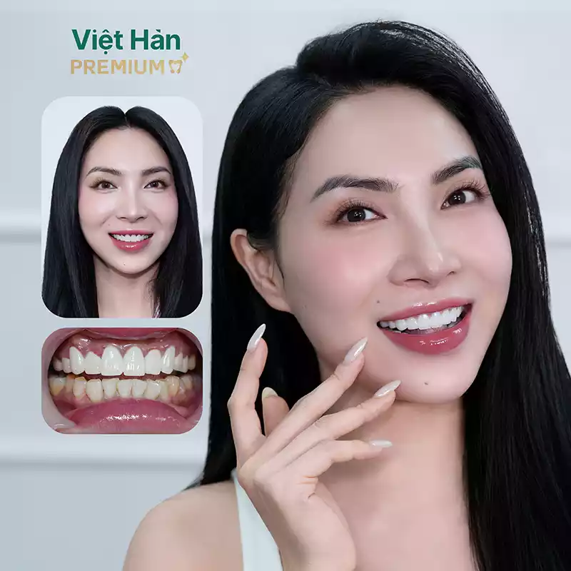 Tiktoker Trish Phan - Bọc 16 răng sứ Lava Plus