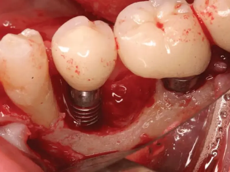 Tình trạng chảy máu kéo dài sau khi cấy ghép Implant 