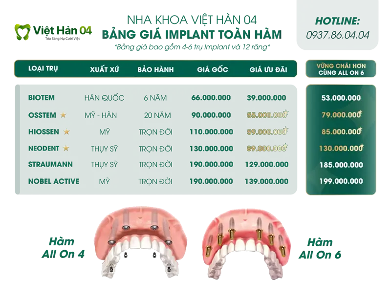 Bảng giá trụ Implant toàn hàm "All On 4 - 6"
