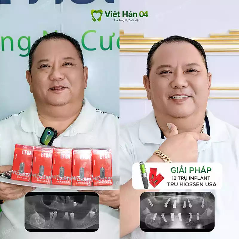Trồng 12 trụ Implant Hiossen USA 