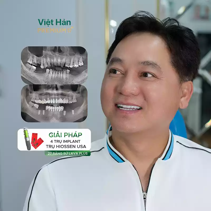 Hình ảnh khách hàng trồng 4 trụ Implant Hiossen hàm dưới và thẩm mỹ 27 răng sứ lava plus