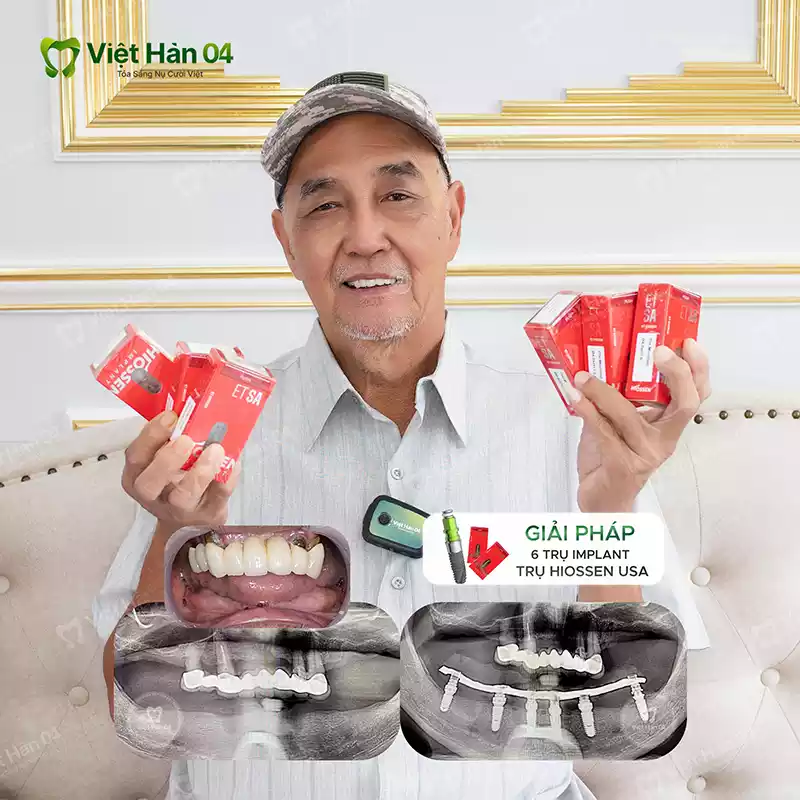 Trồng răng Implant All On 6 hàm dưới - Implant Hiossen USA