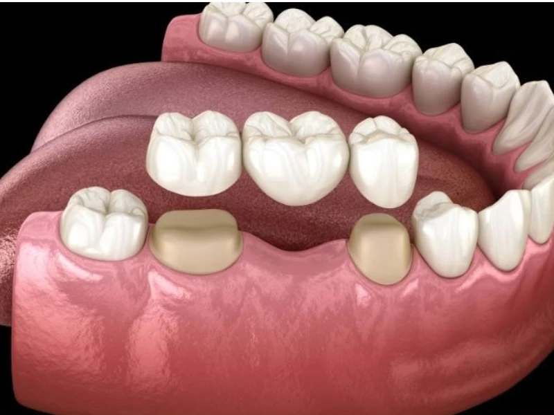 Trồng răng bằng cầu răng sứ