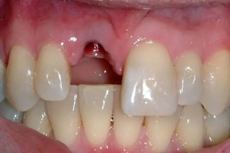Trồng răng cửa bị gãy có được không? 