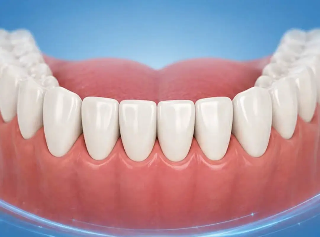 Phục hình răng cửa hàm dưới đảm bảo thẩm mỹ tự nhiên 