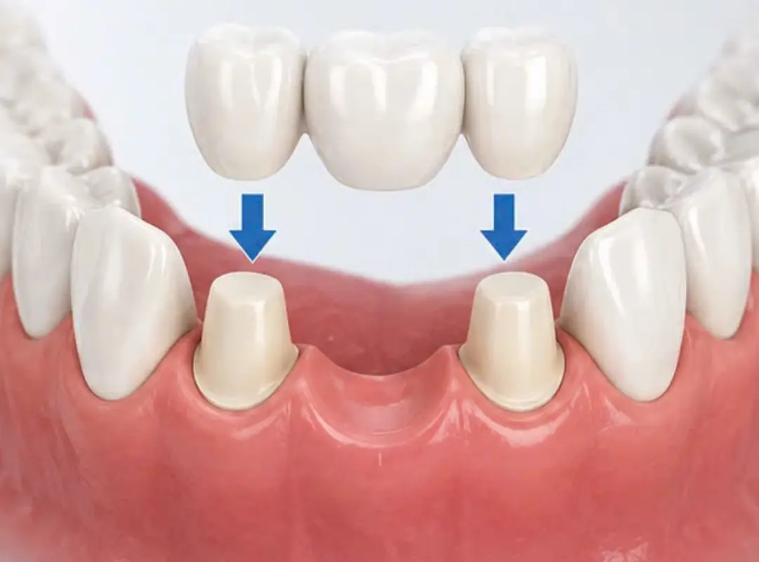 Cầu răng sứ phục hình răng cửa hàm dưới nhanh chóng, thẩm mỹ 