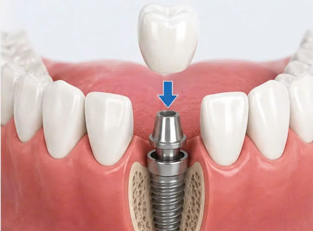 Trồng răng Implant khôi phục răng cửa hàm dưới bền vững 