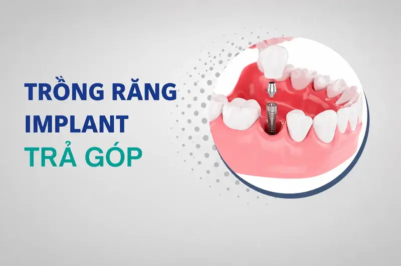 Hỗ trợ trồng răng trả góp 0% lãi suất