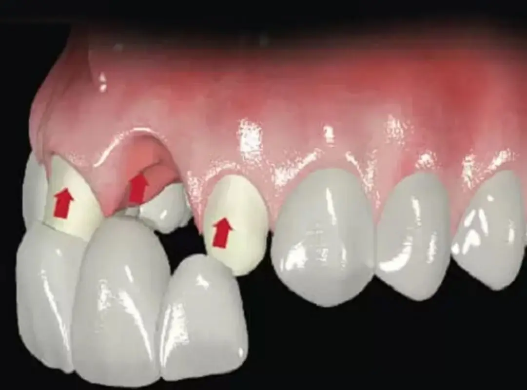 Trồng răng cửa bằng cầu răng sứ phục hồi thẩm mỹ nhanh chóng