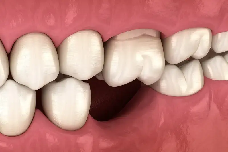 trồng răng bị mất chân răng