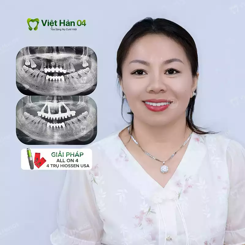 Trồng răng Implant All On 4 Trụ Hiossen USA