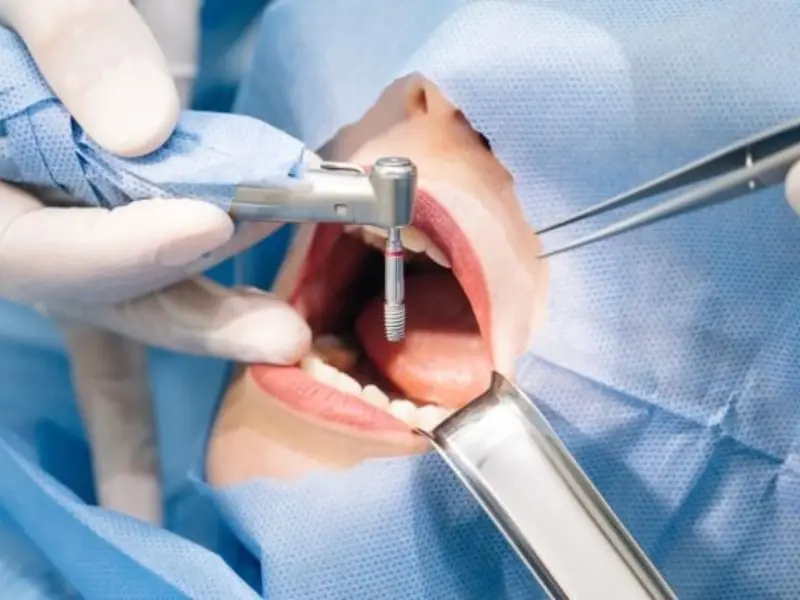 Trồng răng Implant an toàn khi thực hiện đúng kỹ thuật