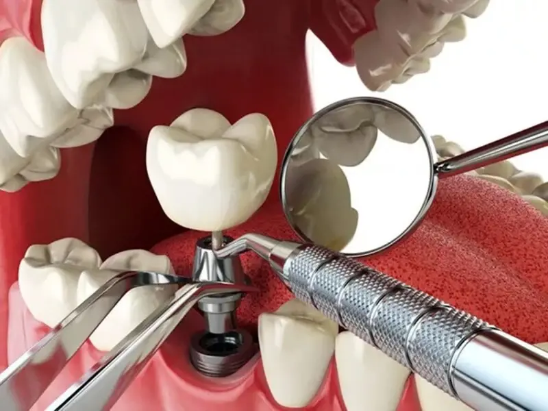 Trồng răng implant không đau nhờ công nghệ gây tê cục bộ hiện đại và kỹ thuật đặt trụ