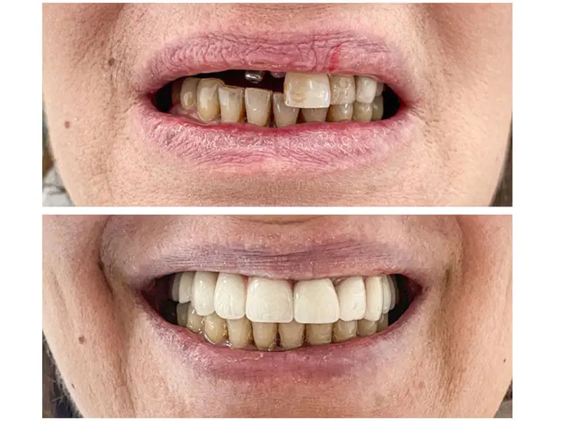 Thời gian hồi phục sau khi trồng răng Implant bao lâu?