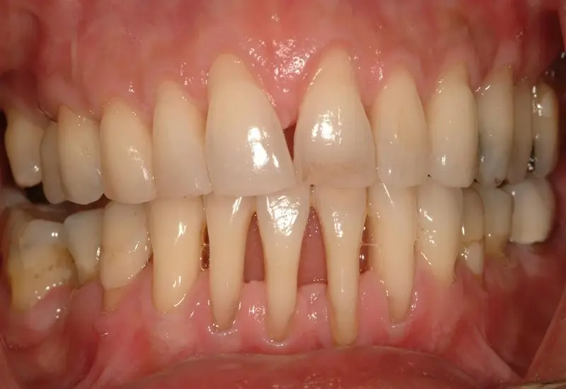 Người có xương hàm tiêu nướu cần tiến hành ghép xương trước khi đặt trụ 