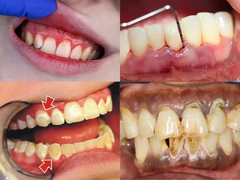 Điều trị dứt điểm bệnh lý răng miệng trước khi cấy ghép Implant