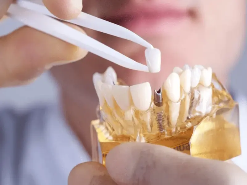 Trồng răng Implant có tuổi thọ lâu dài nếu chăm sóc đúng cách 
