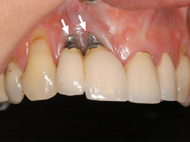 Nhiễm trùng vùng cấy implant 