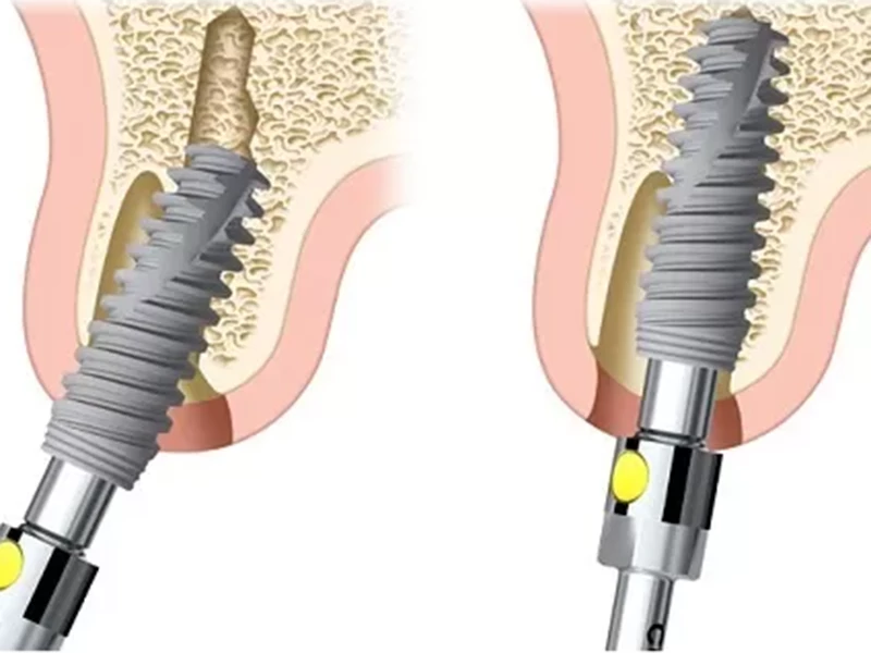 Trồng Implant sai vị trí