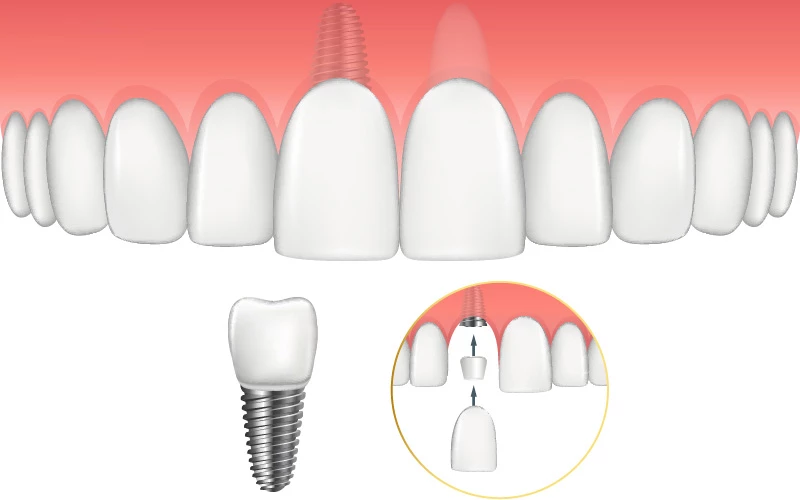 Trồng răng Implant khôi phục răng cửa bị mất giúp ăn nhai tốt và chống tiêu xương