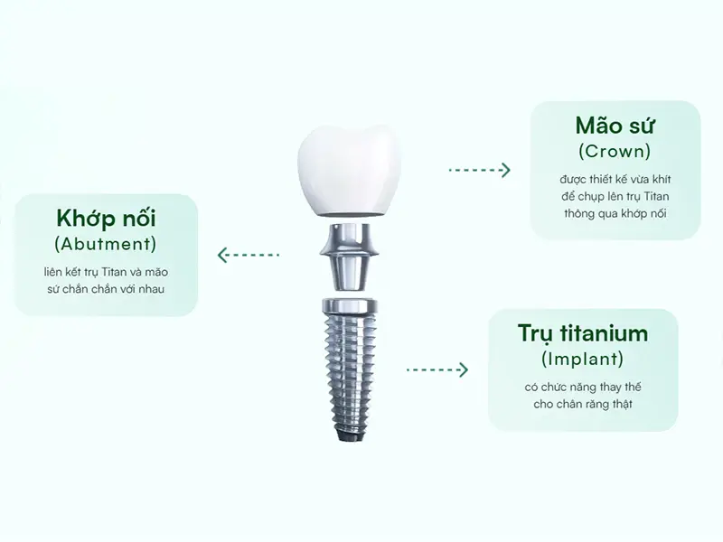 Cấu tạo trụ Implant