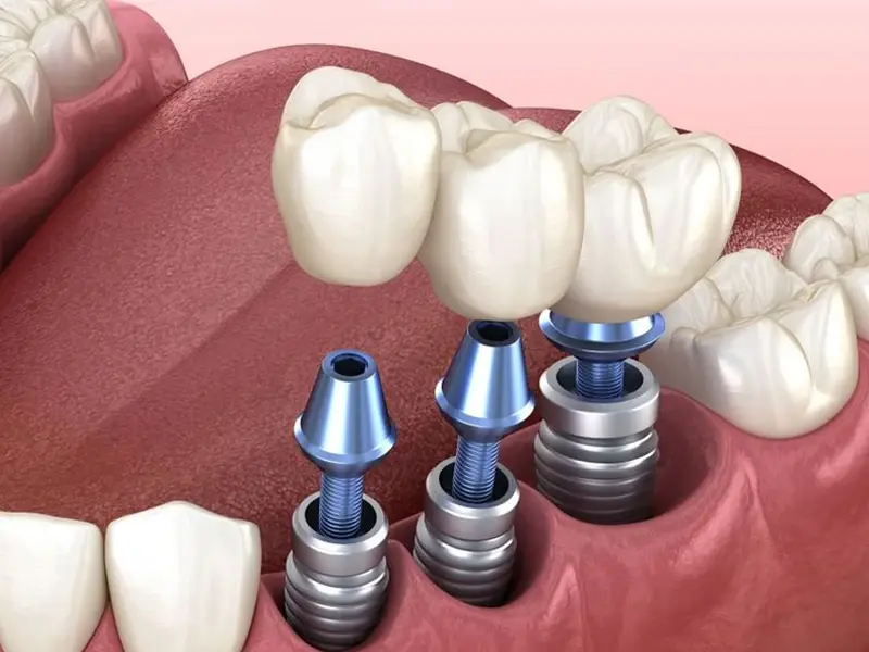 Cấy ghép trụ implant