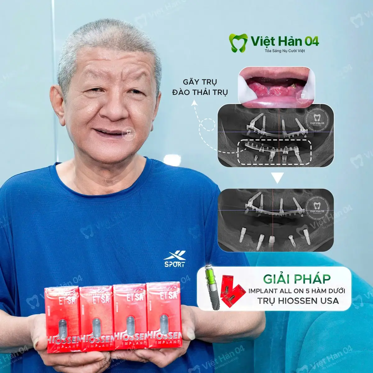 Trụ implant kém chất lượng