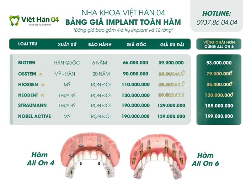 Bảng giá Implant toàn hàm All On 4 - 6 | Nha Khoa Việt Hàn 04
