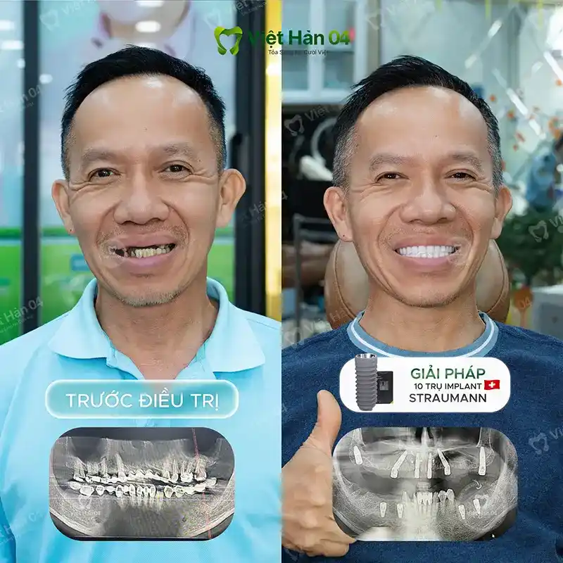 Khách hàng Trung Đình - Việt Kiều Mỹ - Cấy ghép Implant toàn hàm tại Nha khoa Việt Hàn 04