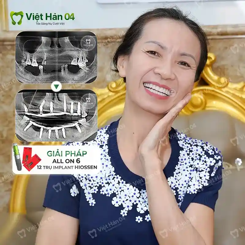 Khách hàng Kim Liên - TPHCM - Cấy ghép Implant All On 6 2 hàm - Nha Khoa Việt Hàn 04