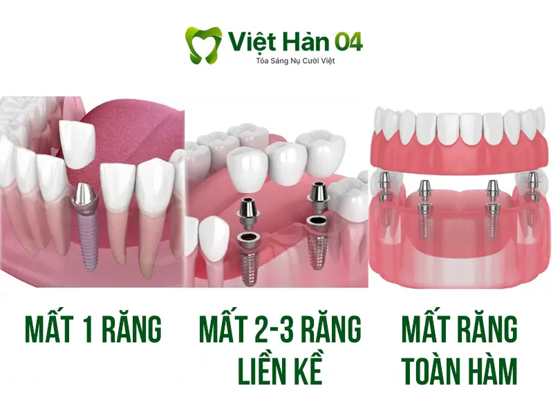 Hình ảnh mất 1 răng, mất 2 - 3 răng liền kề, mất răng toàn hàm