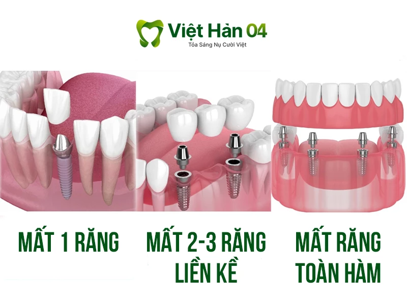 Các phương pháp trồng răng implant