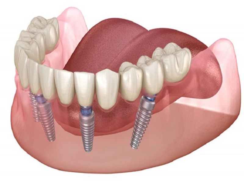 Chi phí trồng răng toàn hàm Implant phụ thuộc vào số lượng trụ cấy và chất liệu răng sứ 